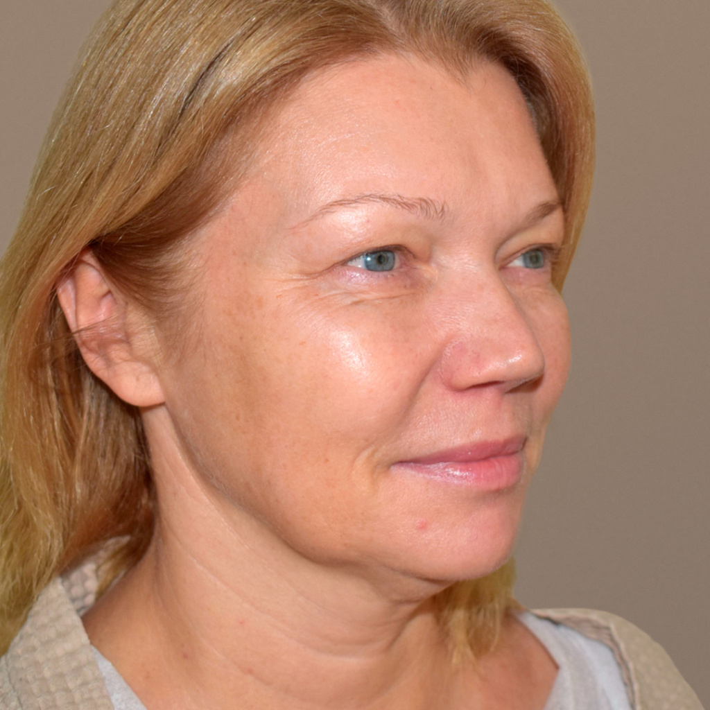 ПХ. Парыгин. Комплексное омоложение. Подтяжка лица, фейслифтинг, платизмопластика, блефаропластика, лобэндоскопия 21