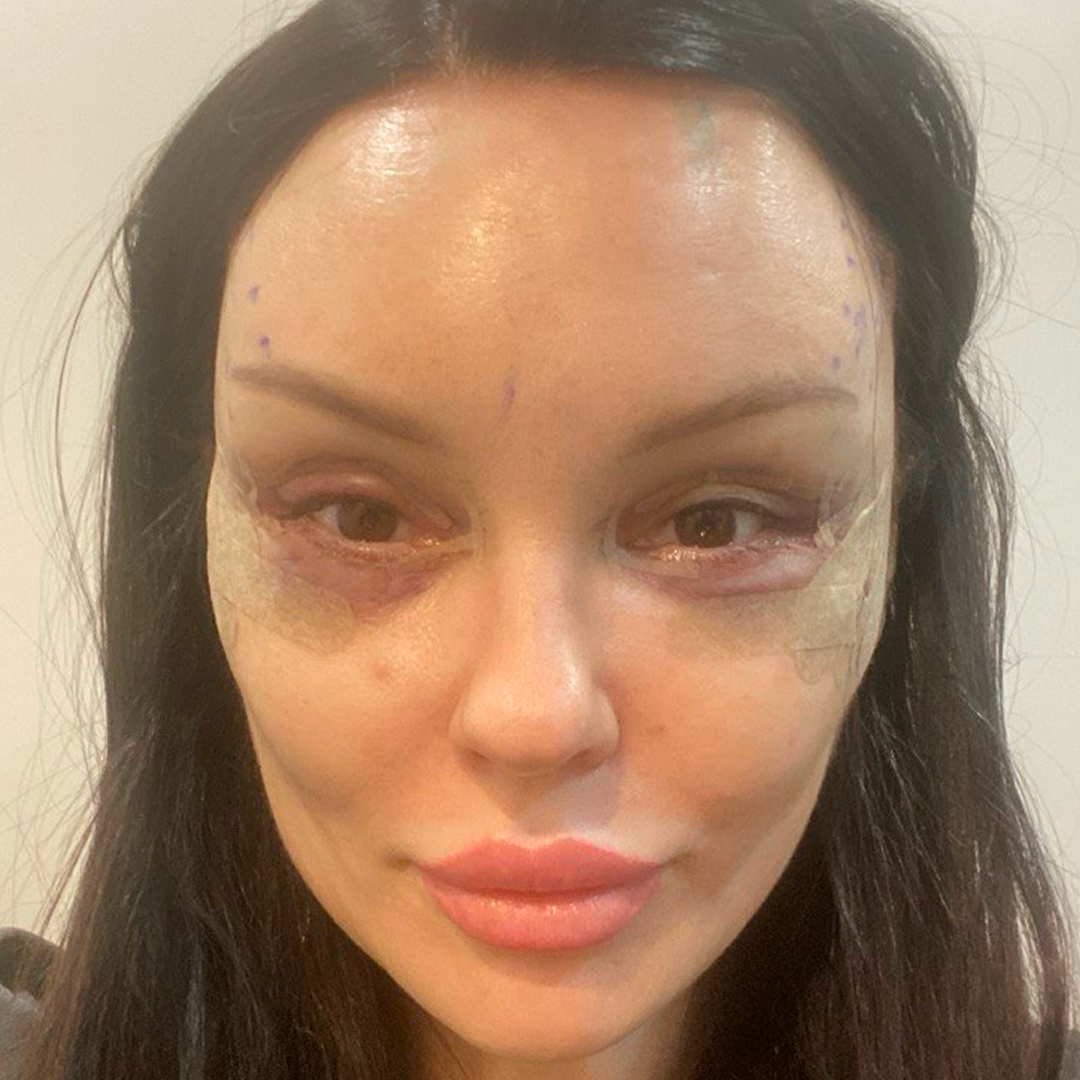 Реабилитация после блефаропластики,<br> 1 день