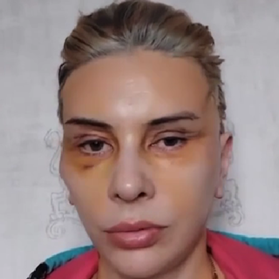 Реабилитация после комплексного омоложения, день 6