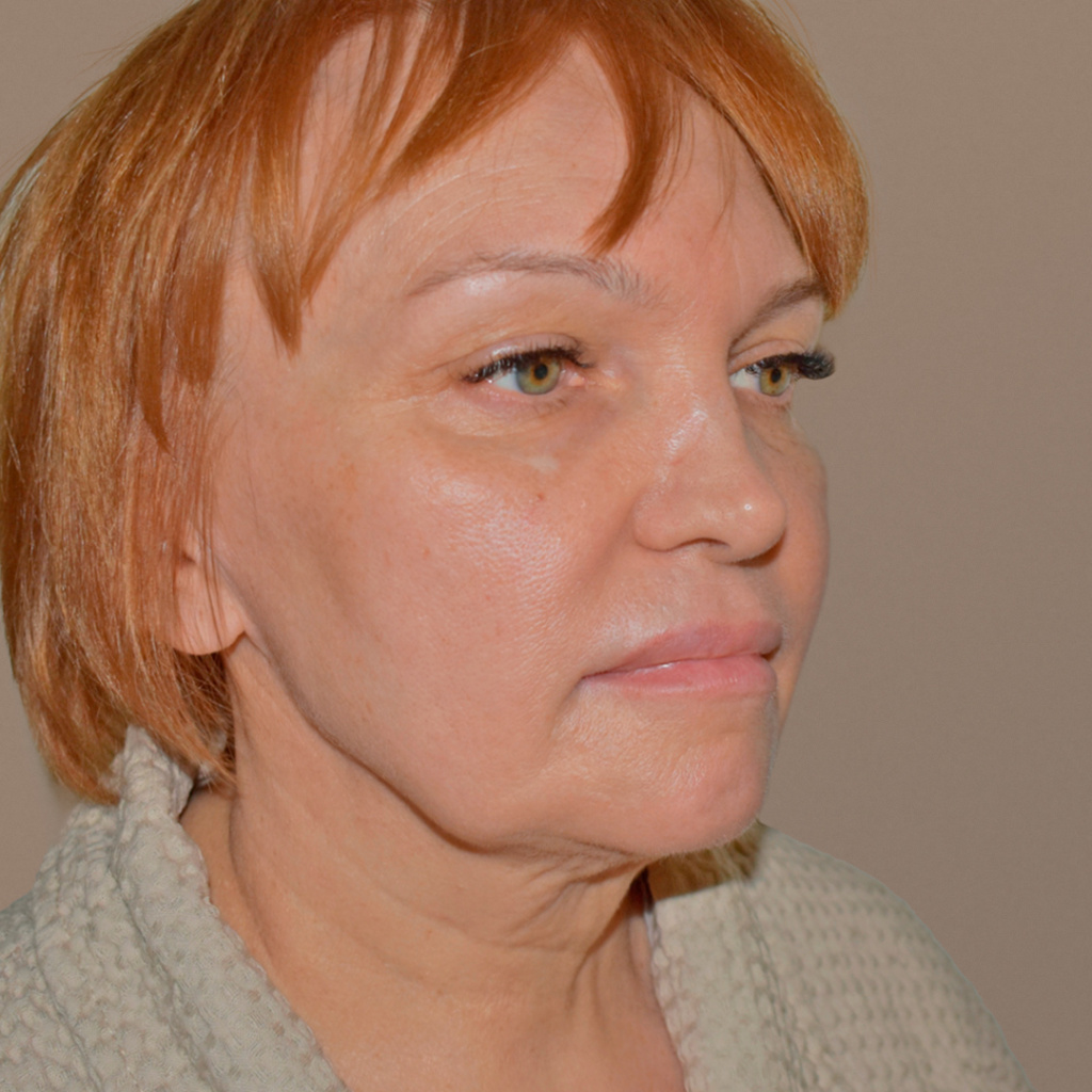 ПХ. Парыгин. Комплексное омоложение. Подтяжка лица, фейслифтинг, платизмопластика, круговая блефаропластика, лобэндоскопия 16