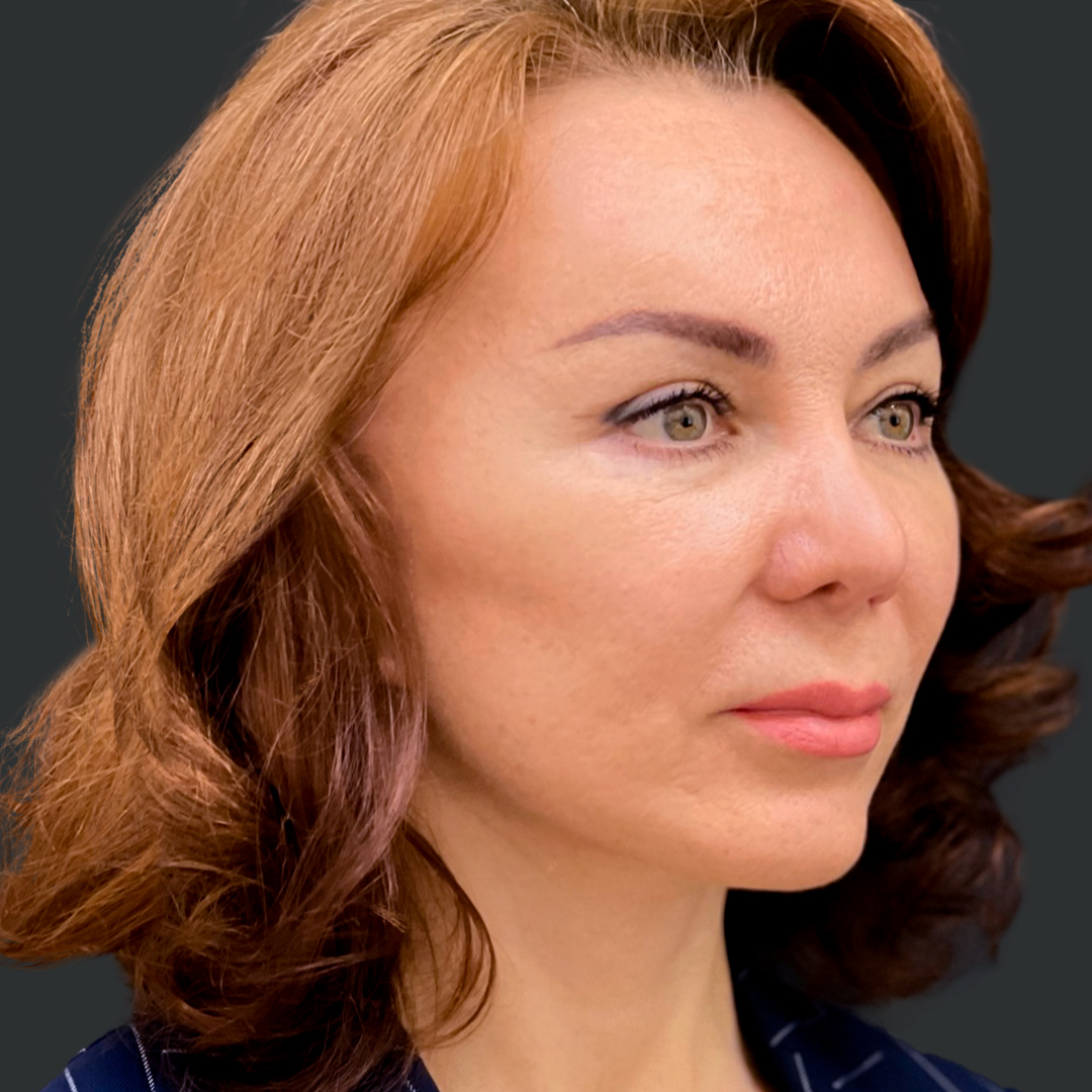 ПХ. Хатри. Комплексное омоложение, фейслифт, подтяжка лица, височный лифтинг, круговая блефаропластика, платизмопластика 1-3
