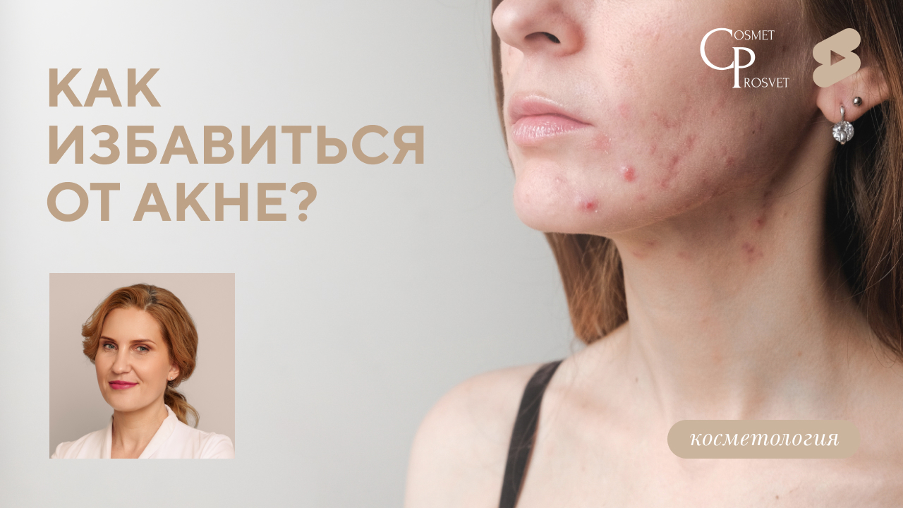 COSMET*ПРОСВЕТ | Как избавиться от акне? (Зятькова К.Ф.)