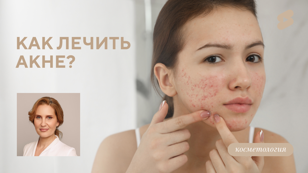 Как лечить акне? (Зятькова К.Ф.)