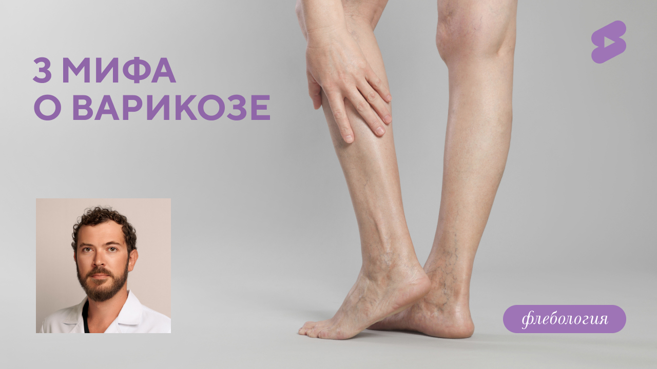 3 мифа про варикоз (Семиголовский С.Н.)