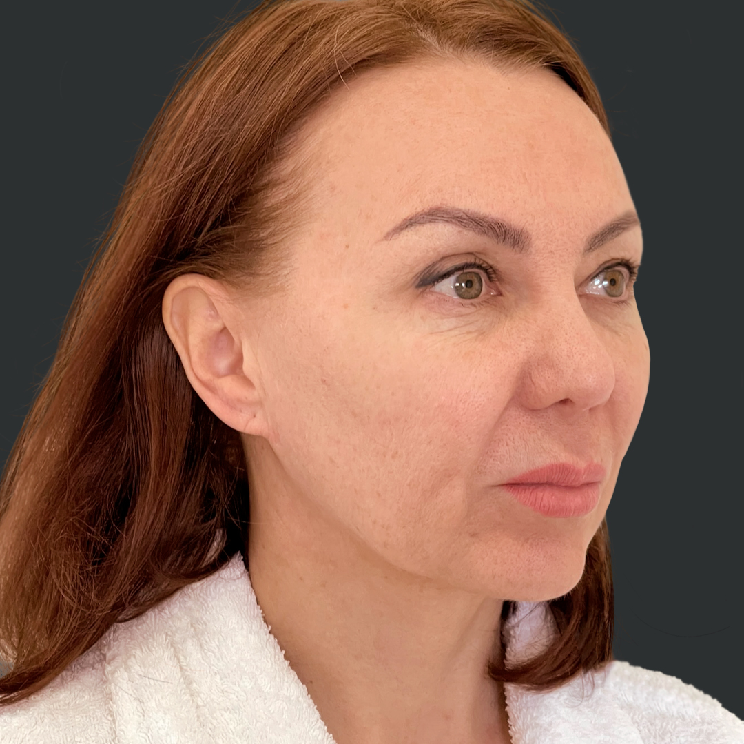ПХ. Хатри. Комплексное омоложение, фейслифт, подтяжка лица, височный лифтинг, круговая блефаропластика, платизмопластика 1-3