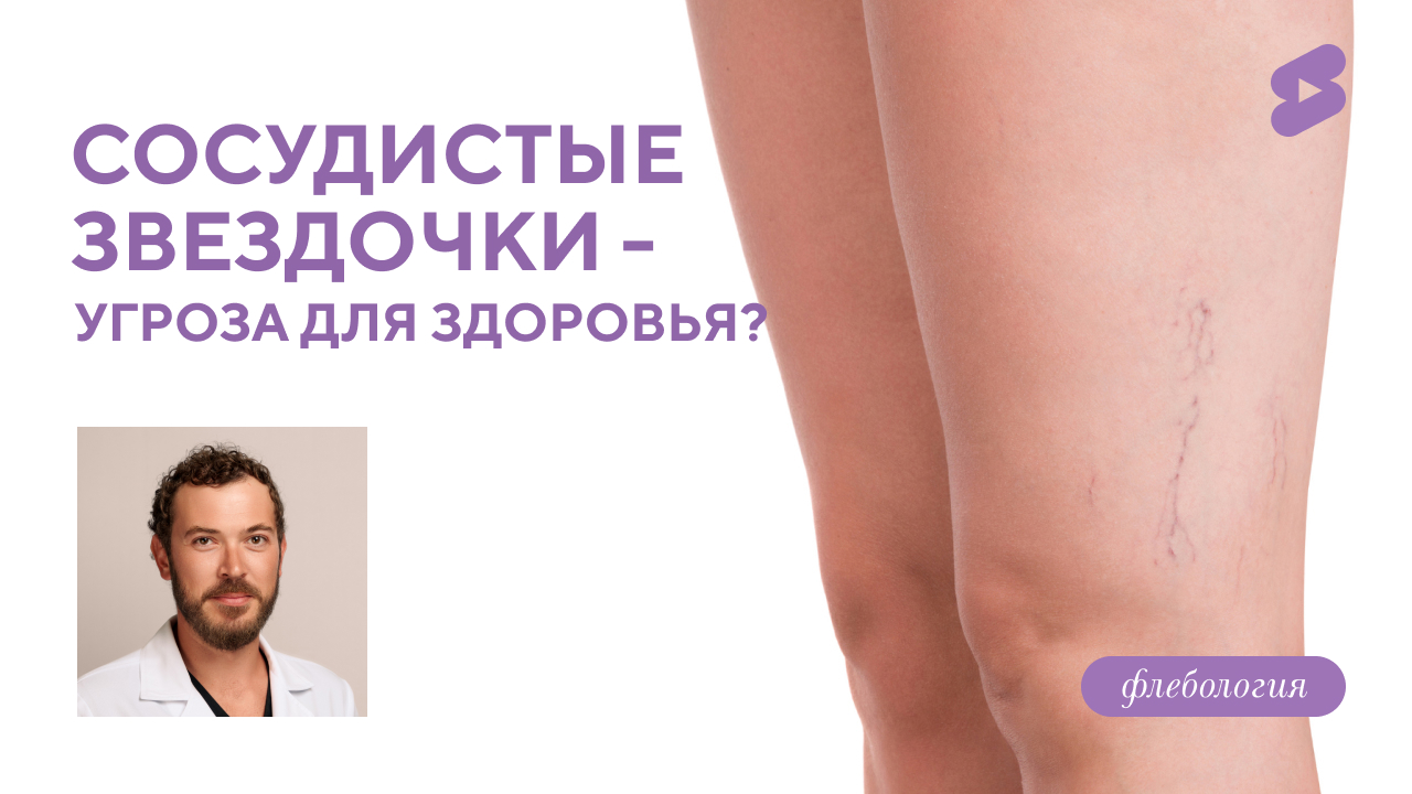 Сосудистые звёздочки - угроза для здоровья? (Семиголовский С.Н.)