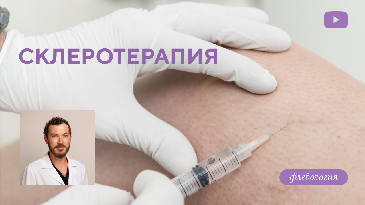 Склеротерапия – безоперационное избавление от сосудистых звездочек! (Семиголовский С.Н.)