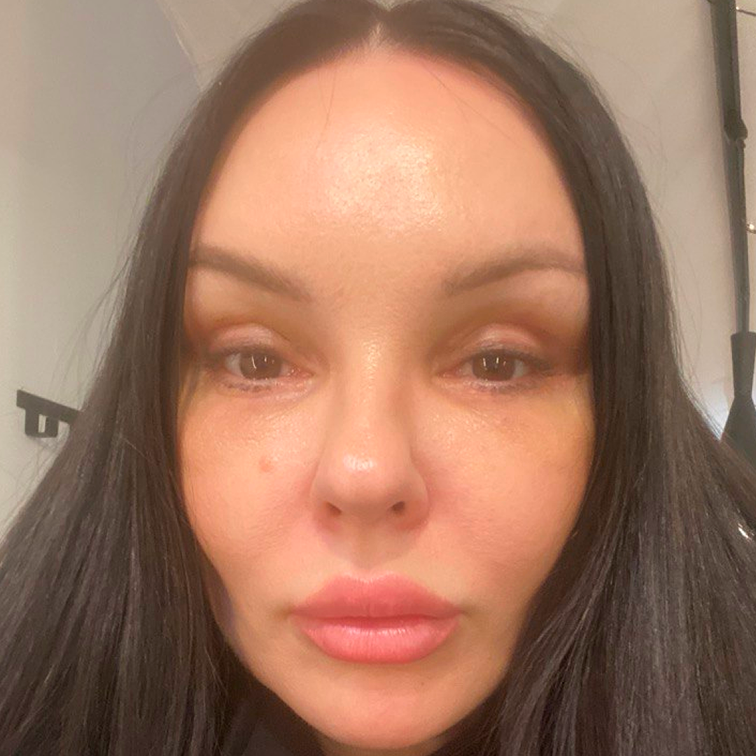 Реабилитация после блефаропластики, <br>7 день