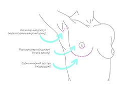 Какой вид доступа лучше при увеличивающей маммопластике?