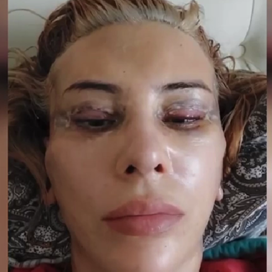 Реабилитация после комплексного омоложения, день 1