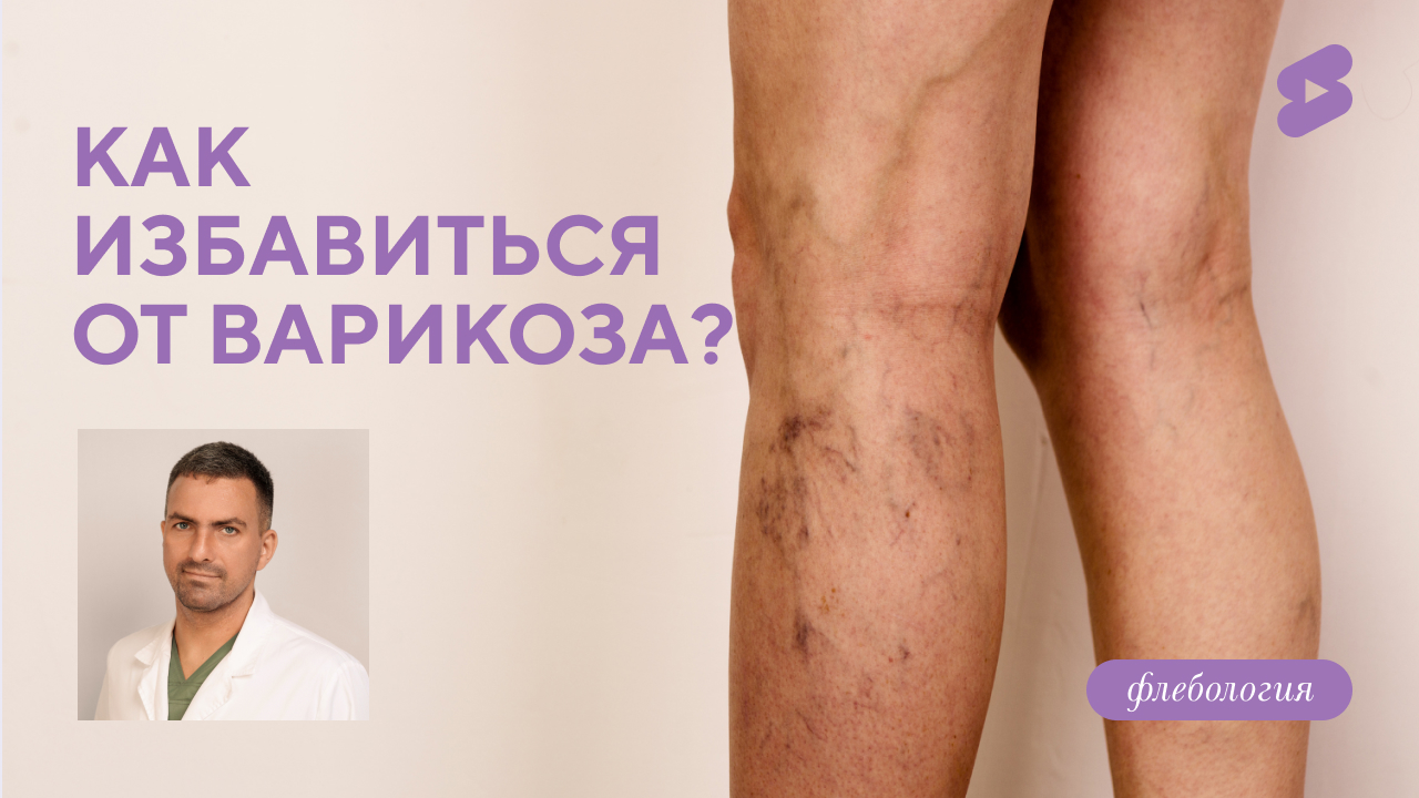 Как избавиться от варикоза? (Дука М.Л.)