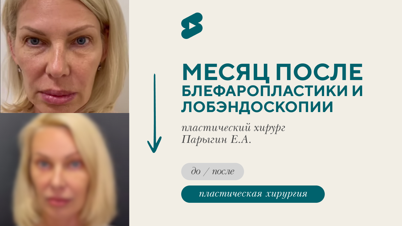 Реабилитация. Месяц после блефаропластики и эндоскопической подтяжки лба. До, процесс, после (Парыгин Е.А.)