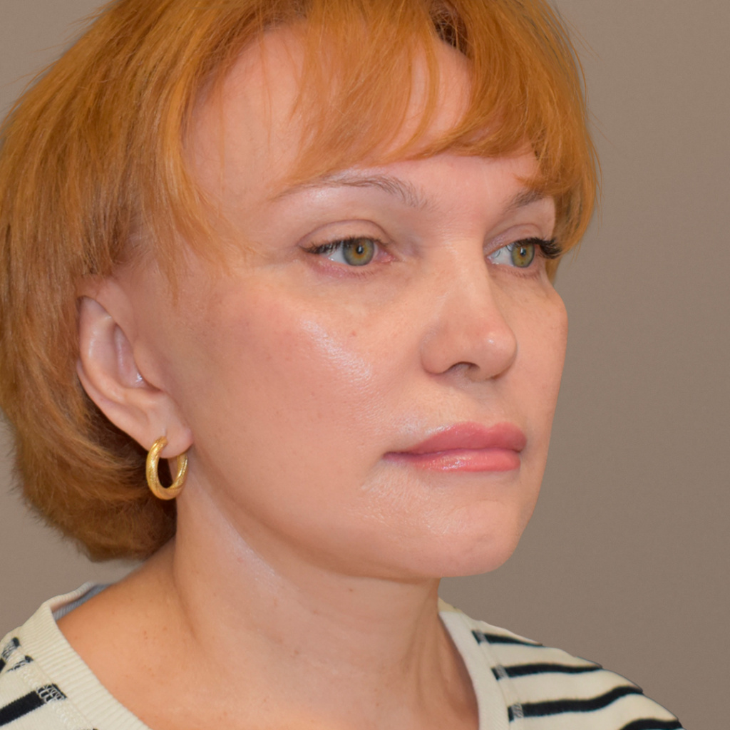 ПХ. Парыгин. Комплексное омоложение. Подтяжка лица, фейслифтинг, платизмопластика, круговая блефаропластика, лобэндоскопия 16