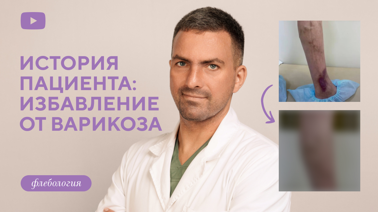 Как убрать варикоз быстро и без боли? (Дука М.Л.)