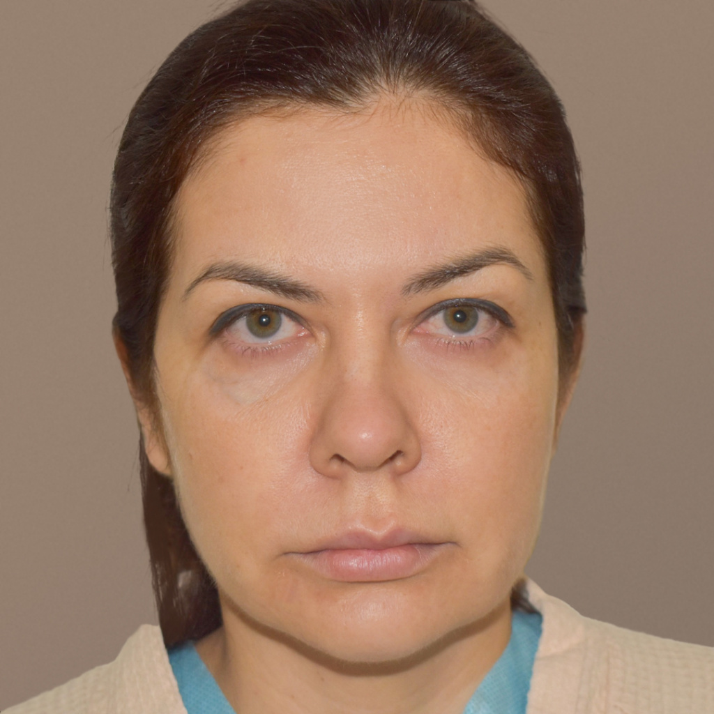 ПХ. Парыгин. Комплексное омоложение, подтяжка лица, фейслифт, платизмопластика, круговая блефаропластика, лобэндоскопия ф4-1