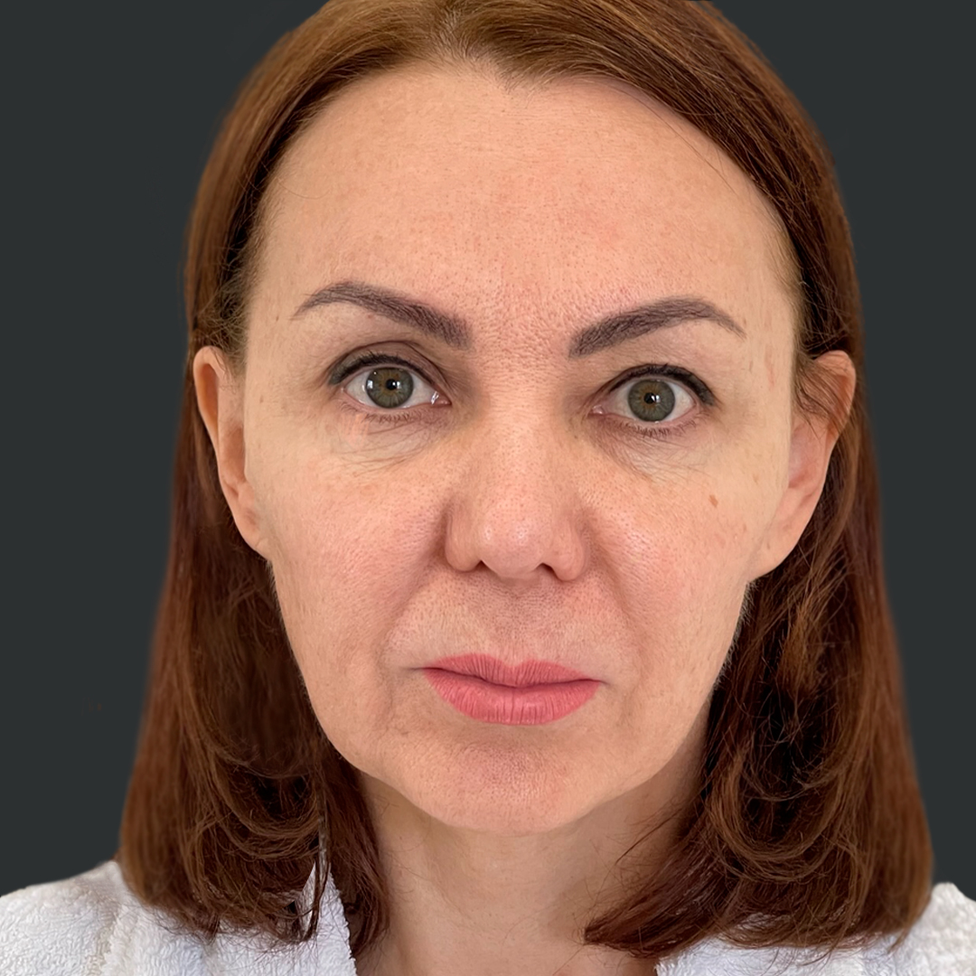 ПХ. Хатри. Комплексное омоложение, фейслифт, подтяжка лица, височный лифтинг, круговая блефаропластика, платизмопластика 1-1