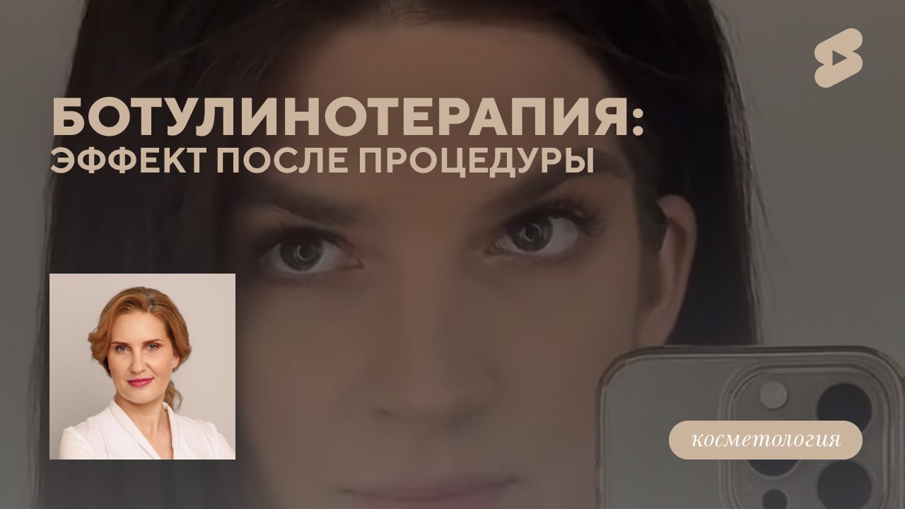 История пациентки:  ботулинотерапия. эффект после процедуры. (Белова О.М.)