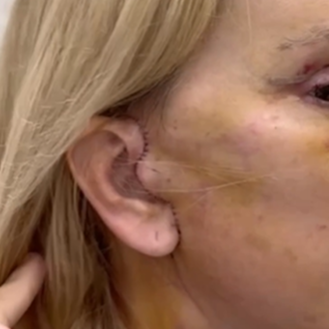 Реабилитация после фейслифтинга, швы на ушах. День 6