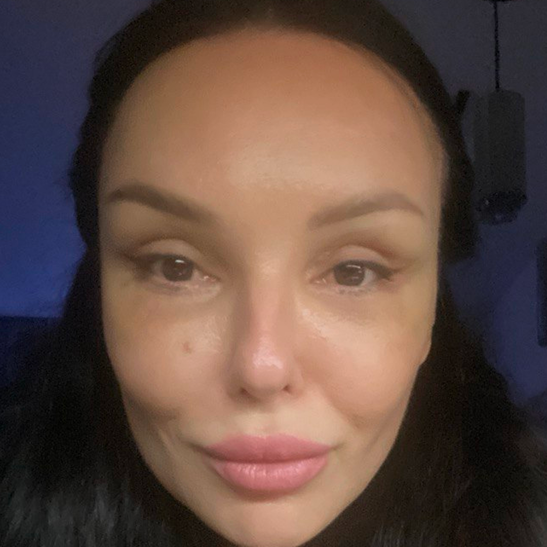 Реабилитация после блефаропластики, <br>8 день