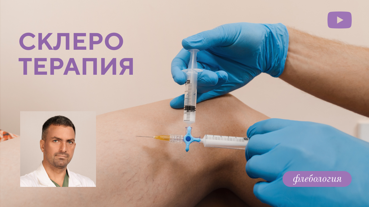 Склеротерапия – современный метод лечения варикоза без операции, а также удаления сосудистых «звездочек» на ногах. (Дука М.Л.)