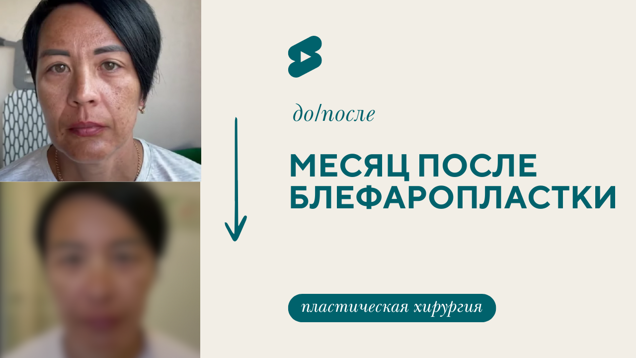 Реабилитация после блефаропластики. До после (Бударин М.С.)