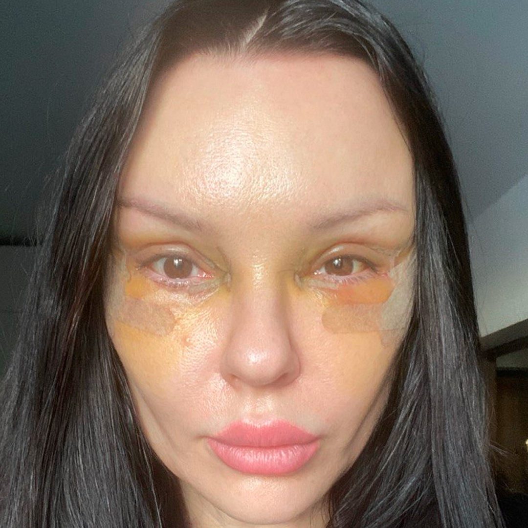 Реабилитация после блефаропластики, <br>5 день