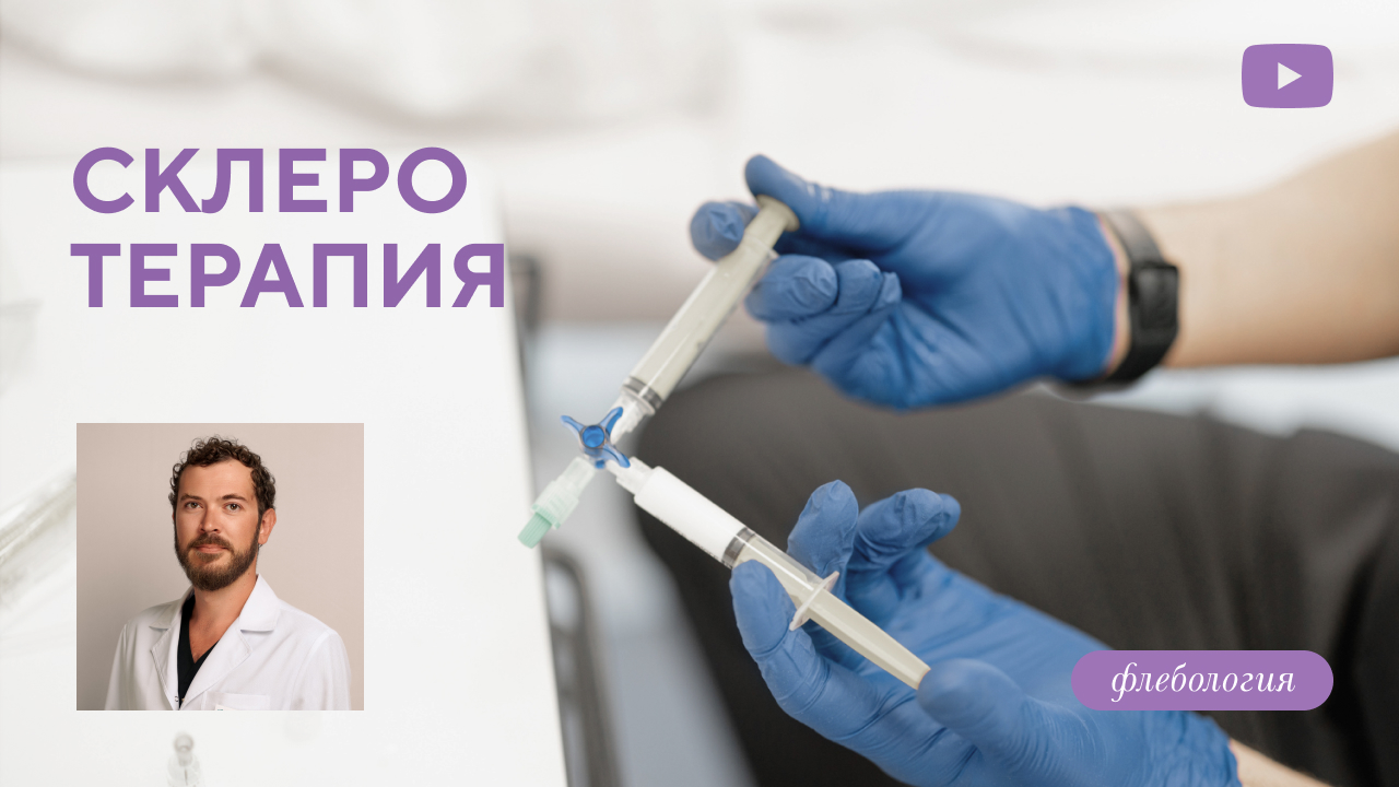 Склеротерапия (Семиголовский С.Н.)