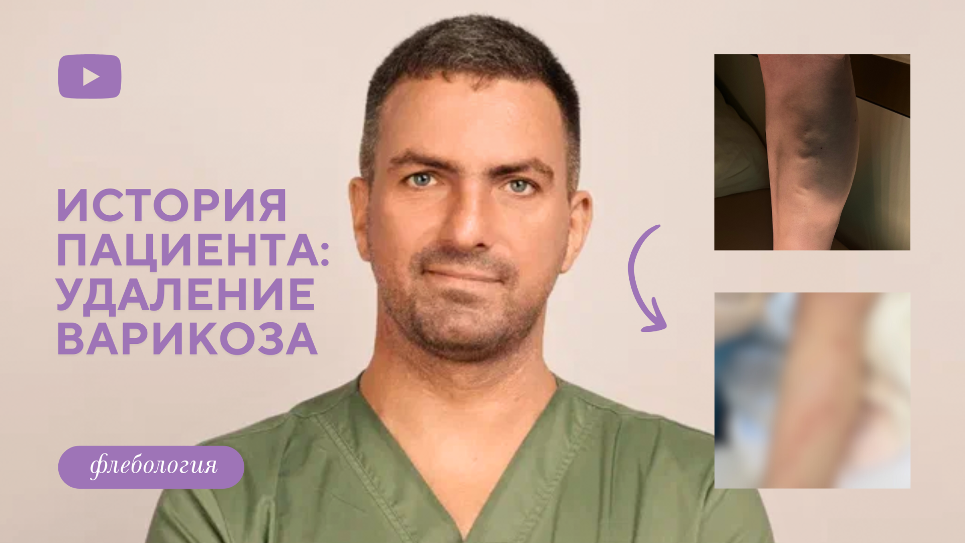 История пациента: комфортное удаление варикоза (Дука М.Л.)