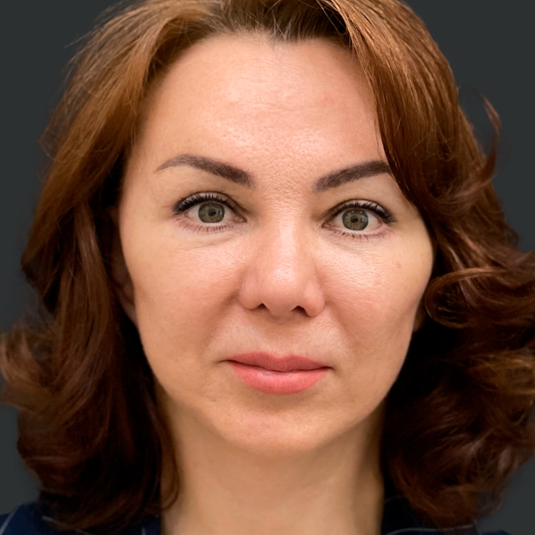 ПХ. Хатри. Комплексное омоложение, фейслифт, подтяжка лица, височный лифтинг, круговая блефаропластика, платизмопластика 1-1