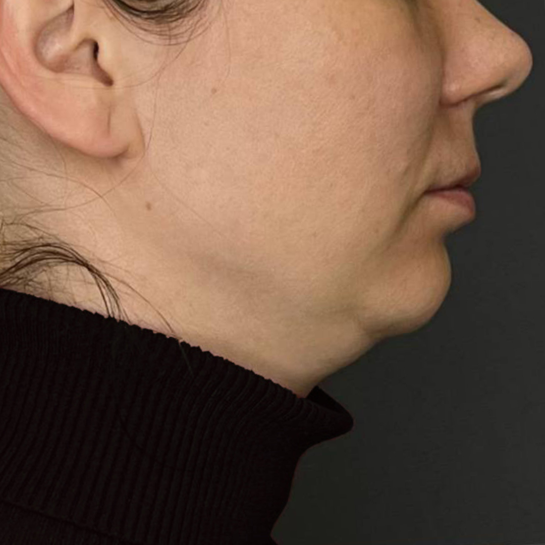 Косметология. Меретякова. аппараты, Ultraformer 1